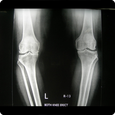 Total Knee Replacement Surgery