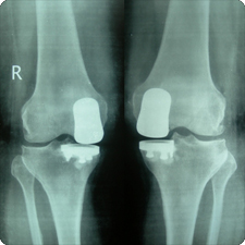 Total Knee Replacement Surgery