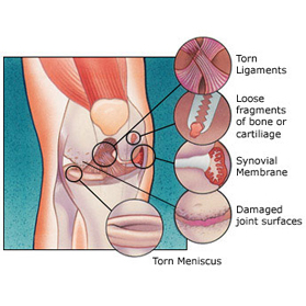 Total-Knee-Replacement