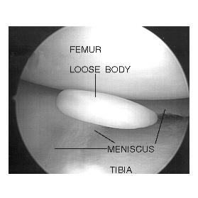 Total-Knee-Replacement