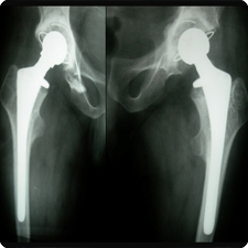 Total Hip Replacement Surgery