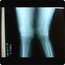 Total Knee Replacement Surgery
