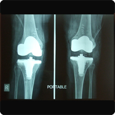 Total Knee Replacement Surgery