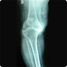 Total Knee Replacement Surgery