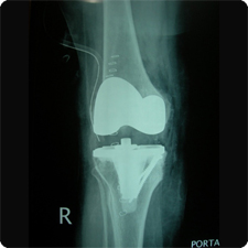 Total Knee Replacement Surgery