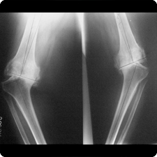 Total Knee Replacement Surgery