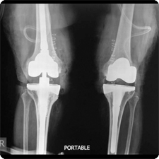 Total Knee Replacement Surgery
