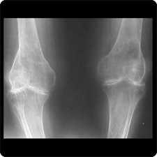 Total Knee Replacement Surgery