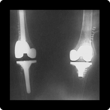 Total Knee Replacement Surgery
