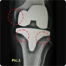 Revision Total Knee Replacement