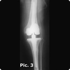 Revision Total Knee Replacement