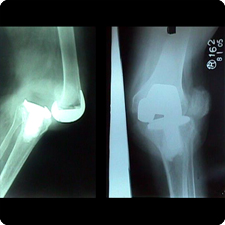 Revision Total Knee Replacement