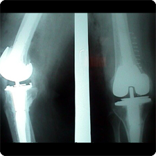 Revision Total Knee Replacement