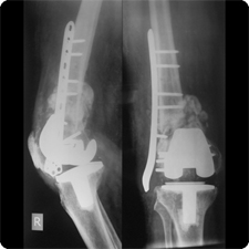 Revision Total Knee Replacement