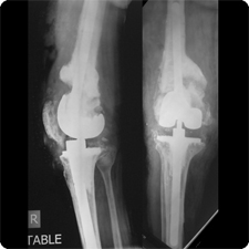 Revision Total Knee Replacement