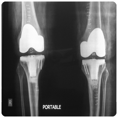 Total Knee Replacement Surgery