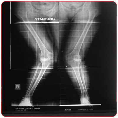 Total Knee Replacement Surgery