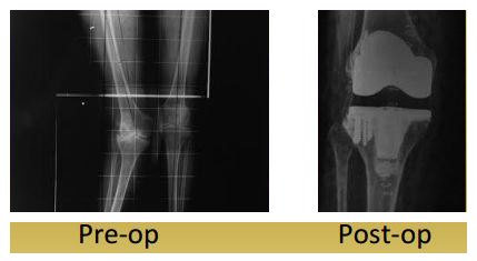 Knee Replacement