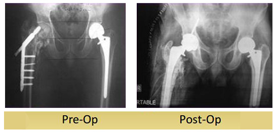 Conversion Of Failed DHS To Total Hip Replacement