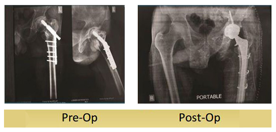 icd 10 code for post traumatic arthritis right hip