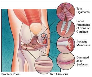 Indications for Knee Arthroscopy 