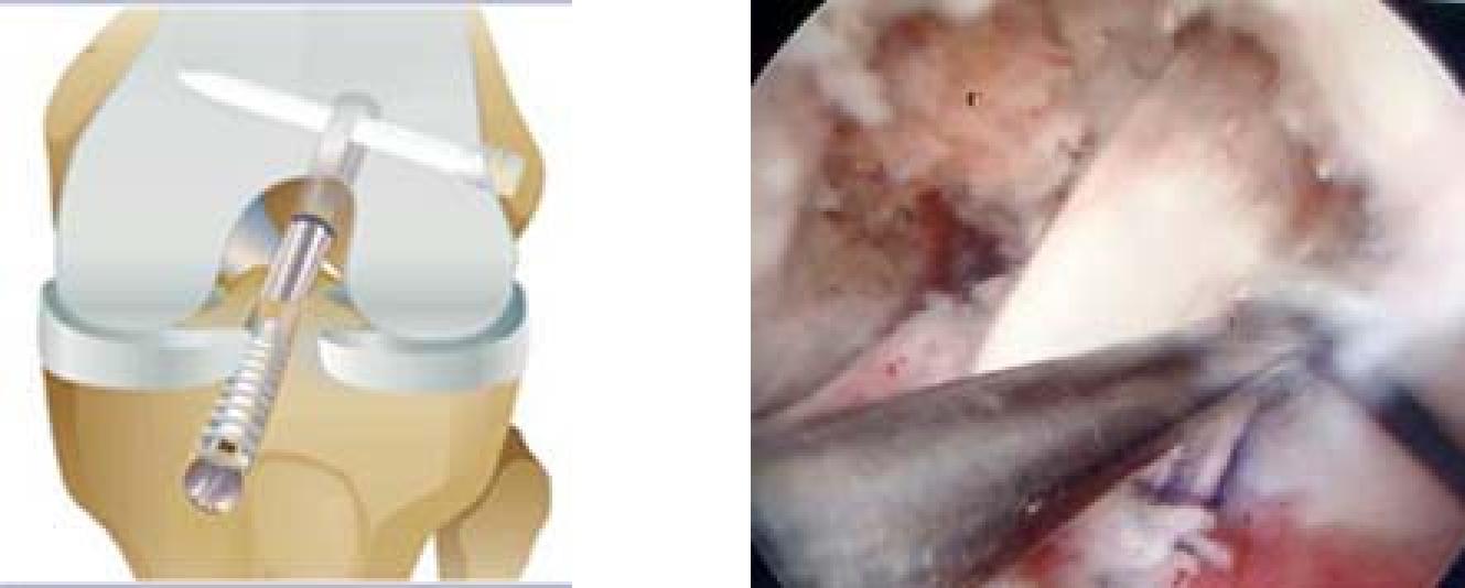 Reconstruction of Anterior Cruciate Ligament(ACL)