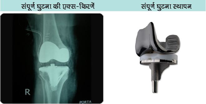 Knee Replacement Faq