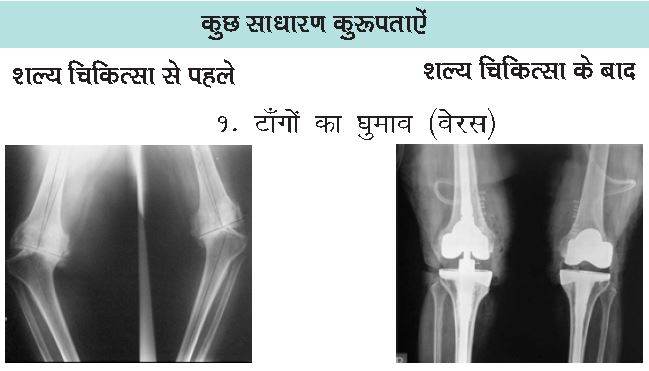 Knee Replacement Faq3