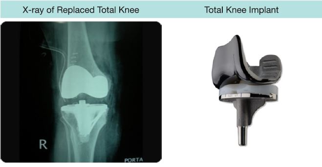 knee1