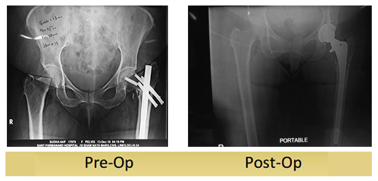 primary-complex-total-hip-replacement-64yr-old