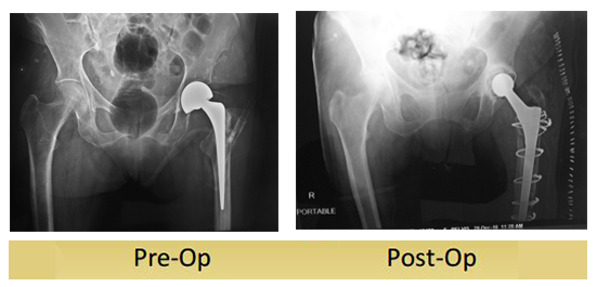 revision-total-hip-replacement-sudhesh- done by 