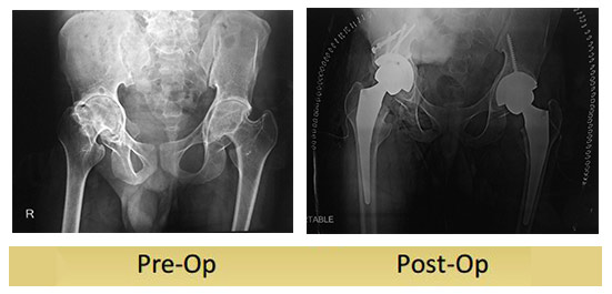 Bilateral-total-hip-replacement