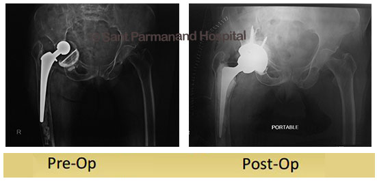 Partial Hip Replacement Dr Shekhar Agarwal Best Knee Hip And Joint Replacement Surgeon In