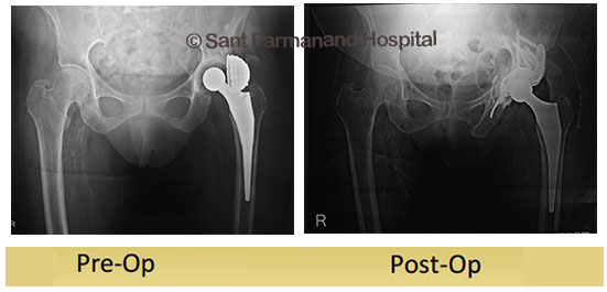 Re-Revision-Total-Hip-replacement