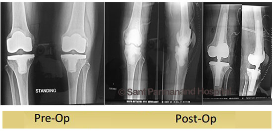 http://www.drshekharagarwal.com/wp-content/uploads/2017/08/revision-knee-replacement-rotating-hinge-done-by-dr-shekhar-agarwal