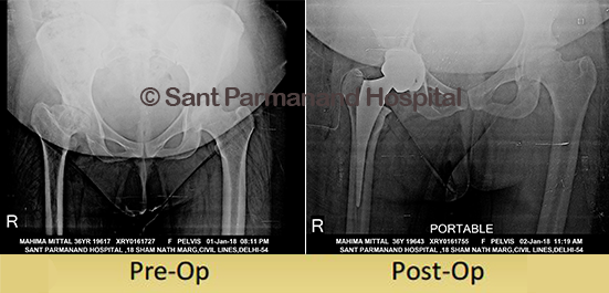 Total-Hip-Replacement-Dysplastic-Hip
