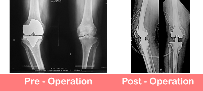 Revision-Total-Knee-Replacement