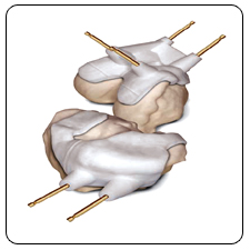 Revision Total Knee Replacement