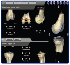 Revision Total Knee Replacement