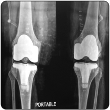 Revision Total Knee Replacement