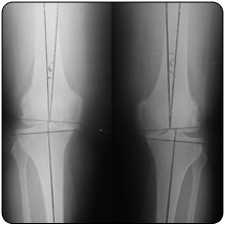 Revision Total Knee Replacement