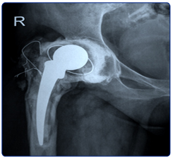 Total Hip Replacement Surgery