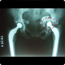 Total Hip Replacement Surgery