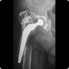 Total Hip Replacement Surgery