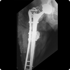 Total Hip Replacement Surgery