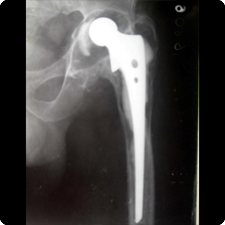 Total Hip Replacement Surgery