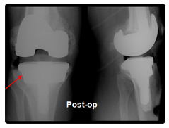 Total Hip Replacement Surgery