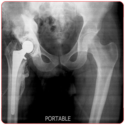 Total Hip Replacement Surgery