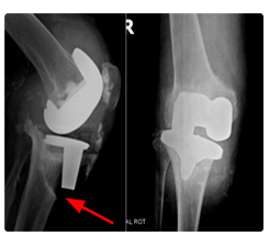 Total Hip Replacement Surgery