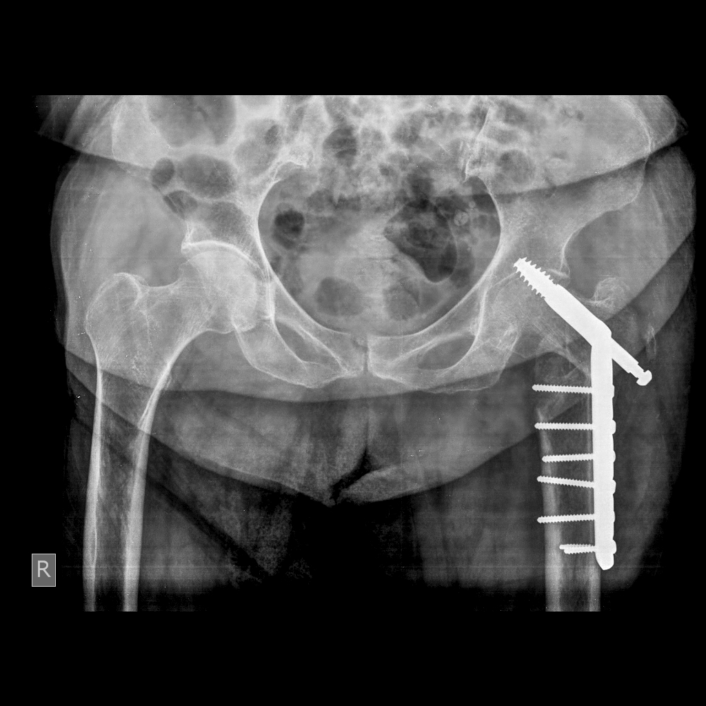 Uncemented Total Hip Replacement Dhs To Thr Conversion Thr Dr